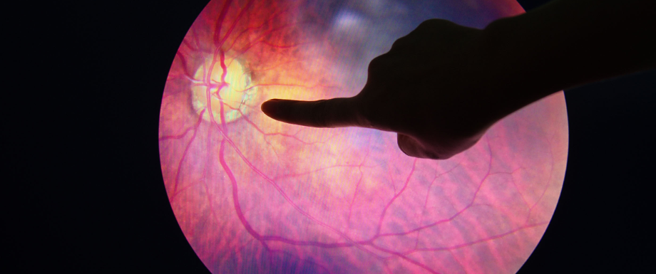 Diabetes and Eyes – Diabetic Retinopathy